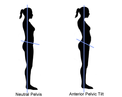anterior pelvic tilt